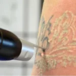Exploring the Latest Technologies in Tattoo Removal