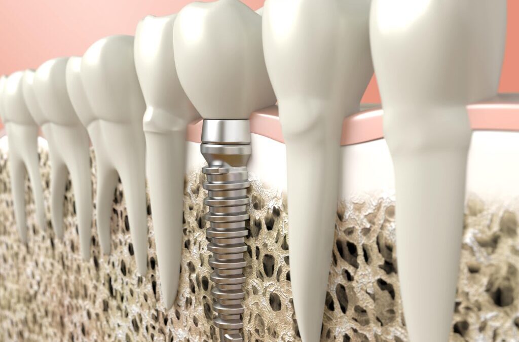 The Advantages of Dental Implants Over Traditional Tooth Replacement