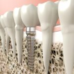 The Advantages of Dental Implants Over Traditional Tooth Replacement