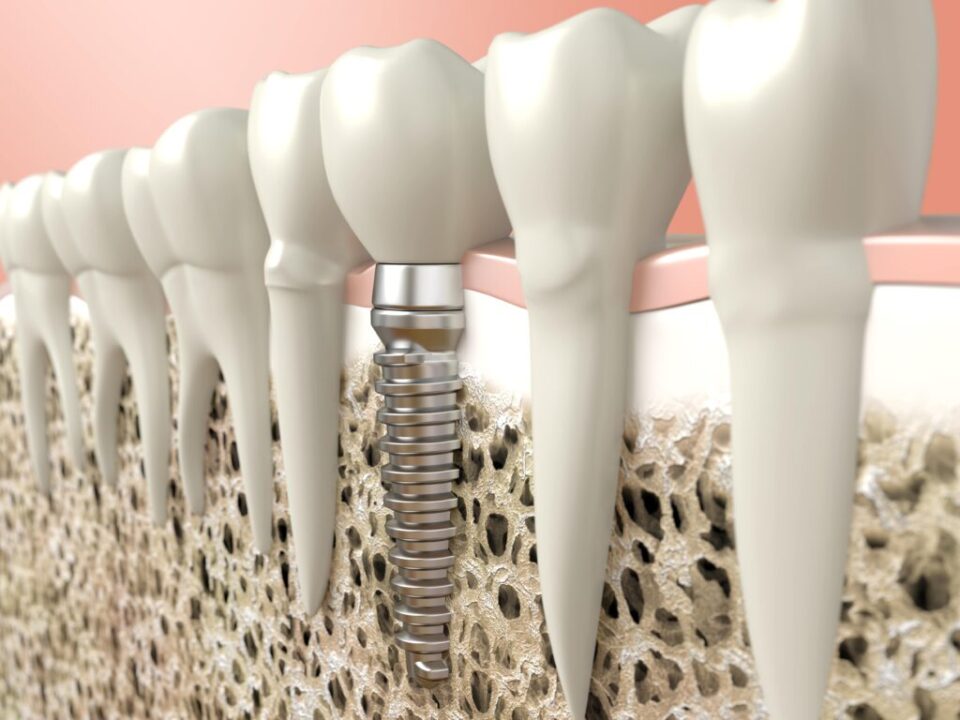 The Advantages of Dental Implants Over Traditional Tooth Replacement